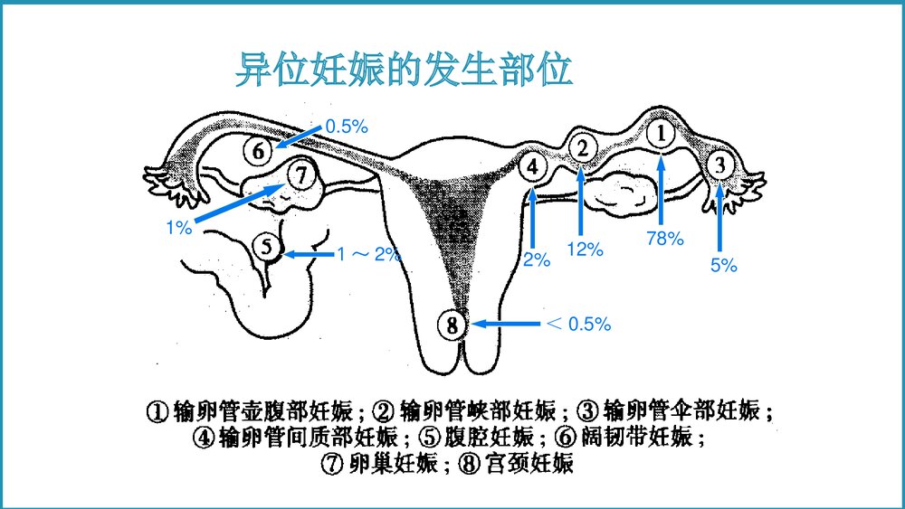 异位妊娠教学课件PPT5