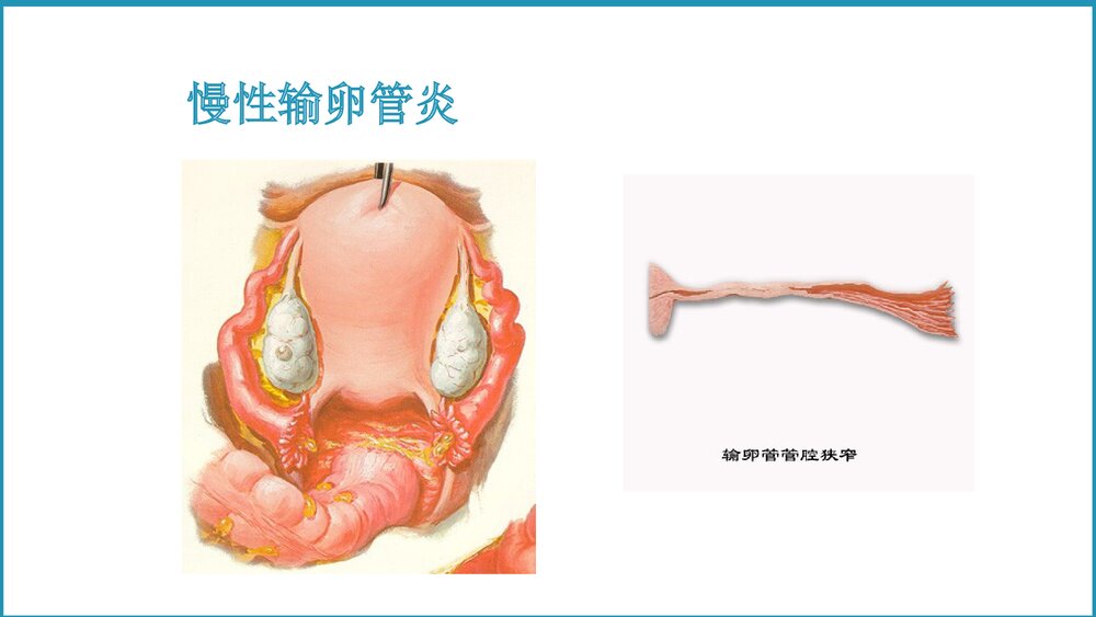 异位妊娠教学课件PPT9