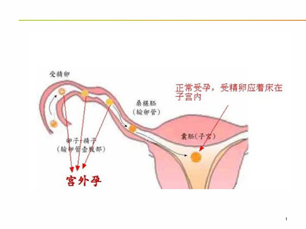 宫外孕的急救护理PPT课件8