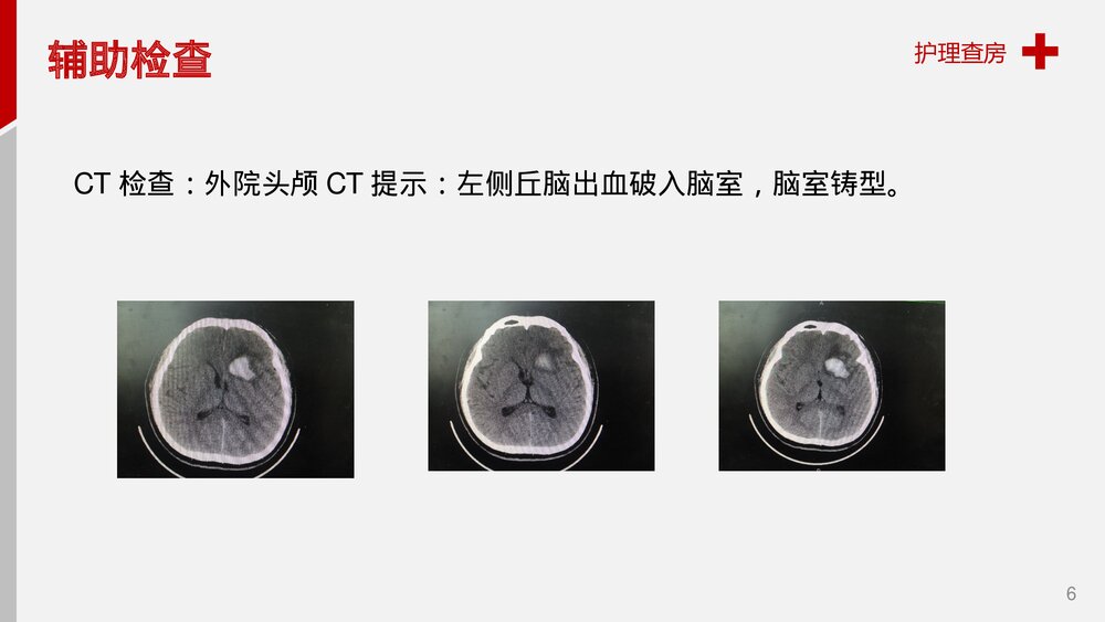 脑出血护理查房健康教育PPT课件6