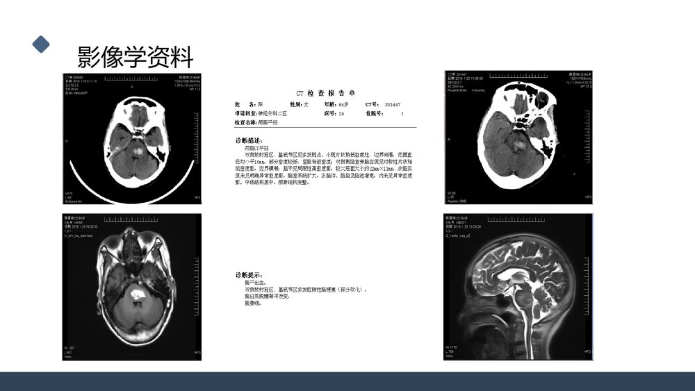 一例桥脑出血的护理个案分享PPT课件10