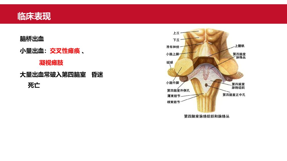 脑出血患者治疗护理保健指导PPT课件10