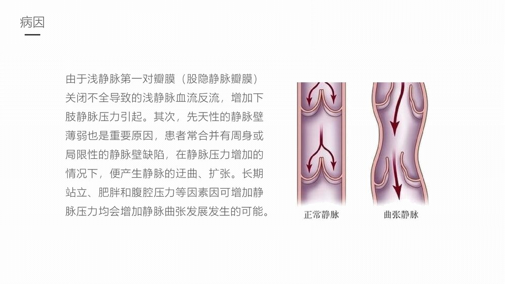 下肢静脉曲张的护理业务学习课件6