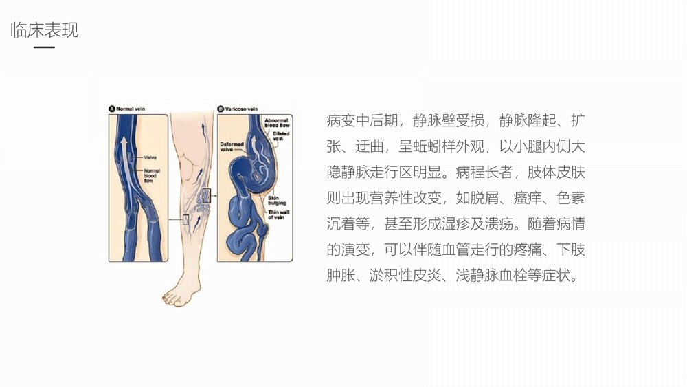 下肢静脉曲张的护理业务学习课件9