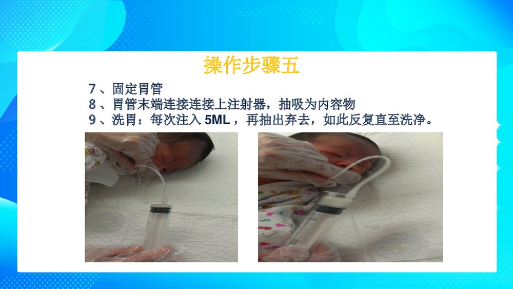 新生儿洗胃操作方法PPT课件10