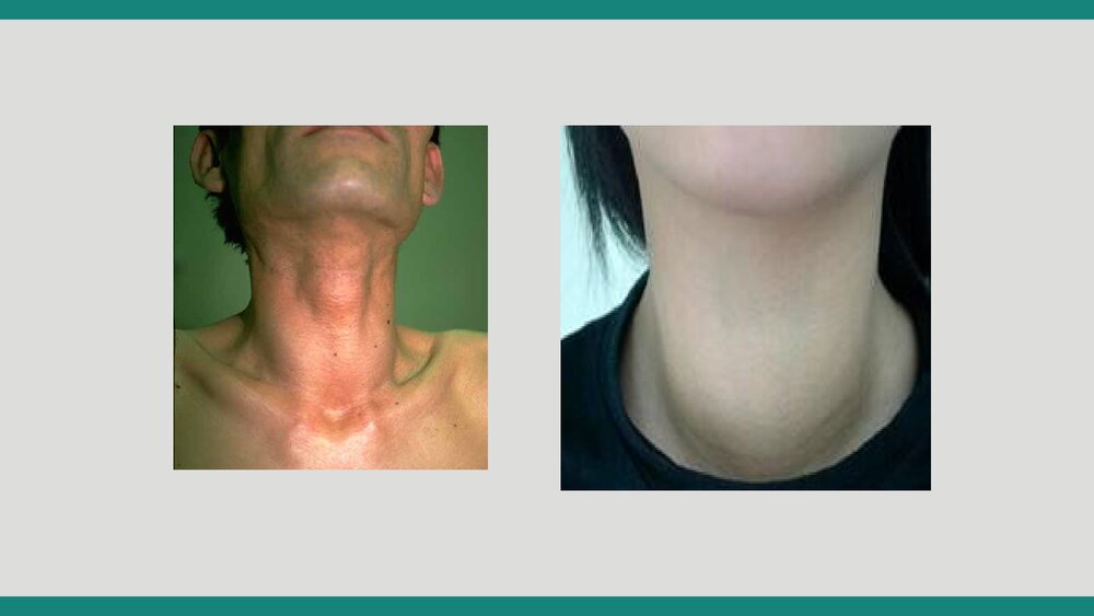 甲状腺术后病人护理查房PPT课件9