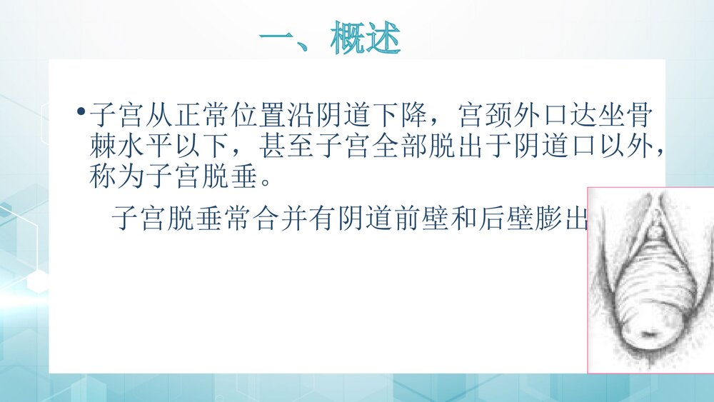 子宫脱垂ppt课件 临床表现治疗护理常规3