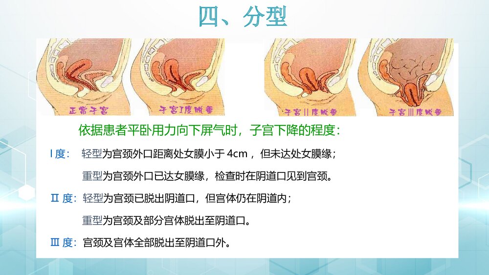 子宫脱垂ppt课件 临床表现治疗护理常规6