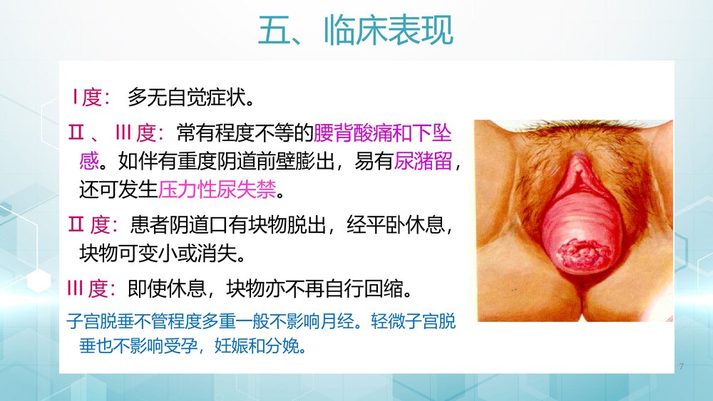 子宫脱垂ppt课件 临床表现治疗护理常规7