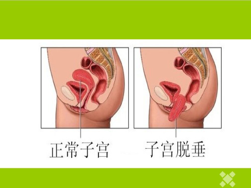 子宫脱垂患者的护理PPT课件5