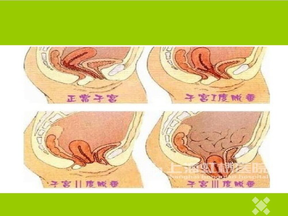 子宫脱垂患者的护理PPT课件9