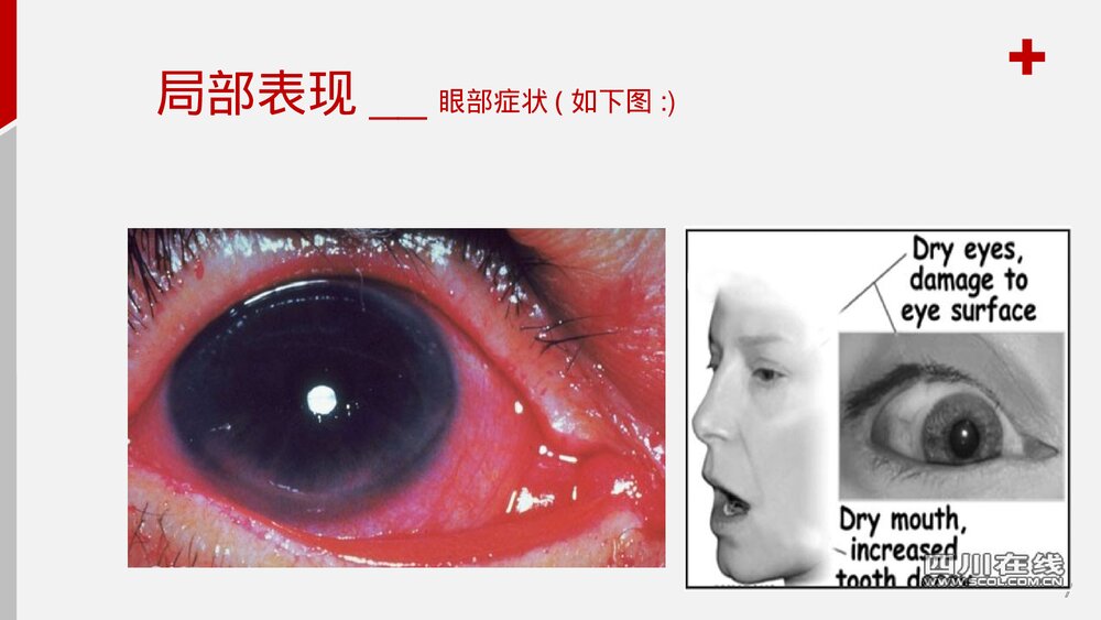 干燥综合症护理查房PPT课件7