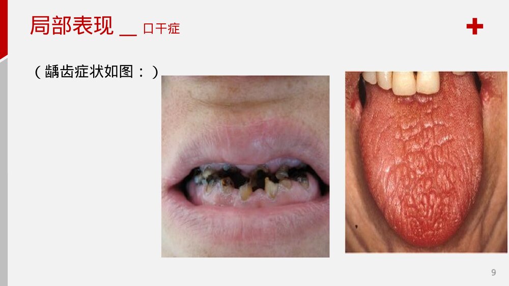 干燥综合症护理查房PPT课件9