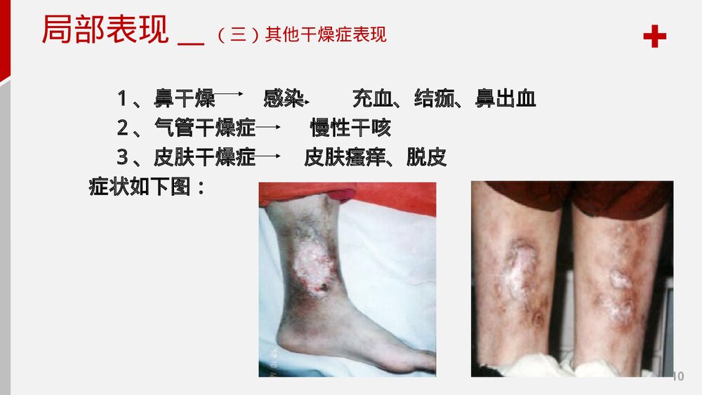 干燥综合症护理查房PPT课件10