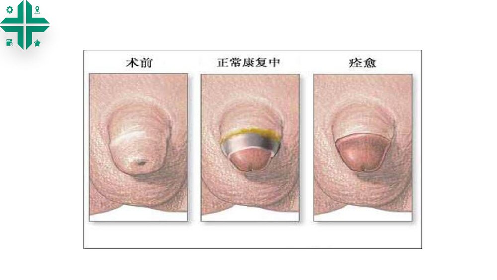 包皮包茎课件PPT课件6
