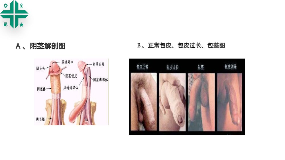 包皮包茎课件PPT课件8