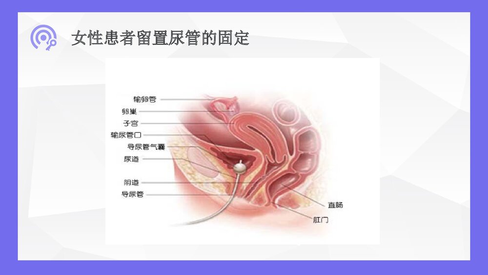 导尿术的操作流程及并发症处理ppt9