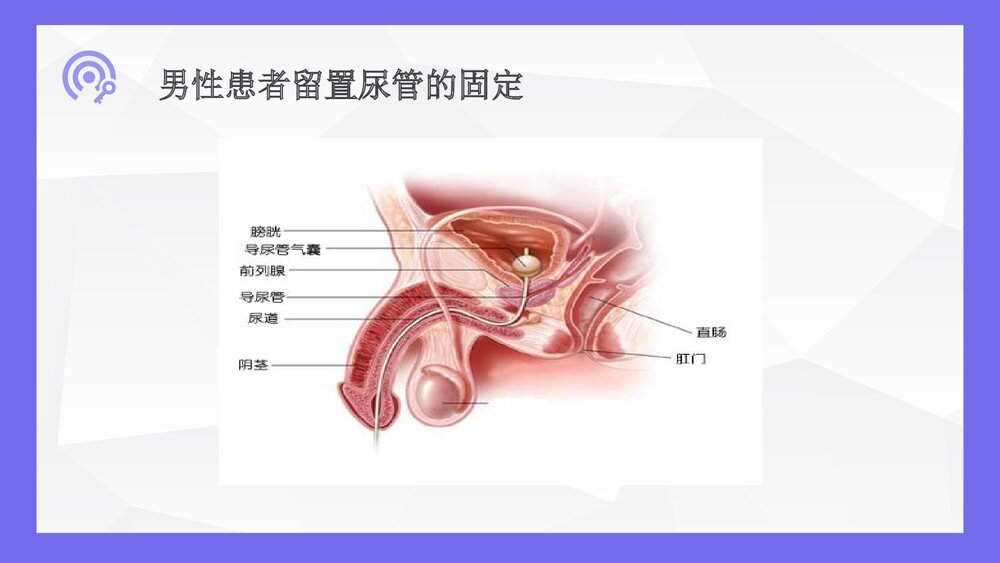 导尿术的操作流程及并发症处理ppt10