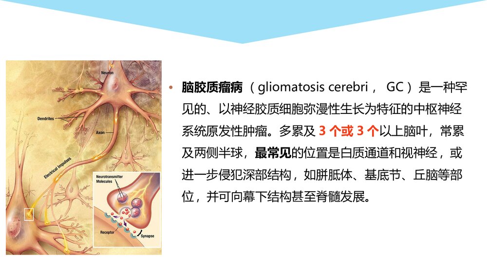 大脑胶质瘤病影像学诊断PPT课件3