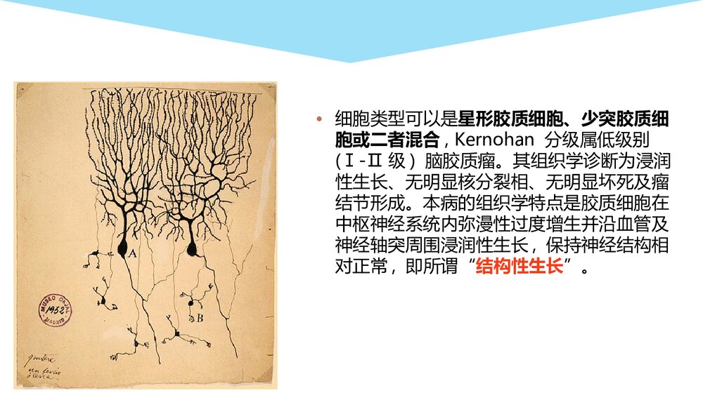 大脑胶质瘤病影像学诊断PPT课件7