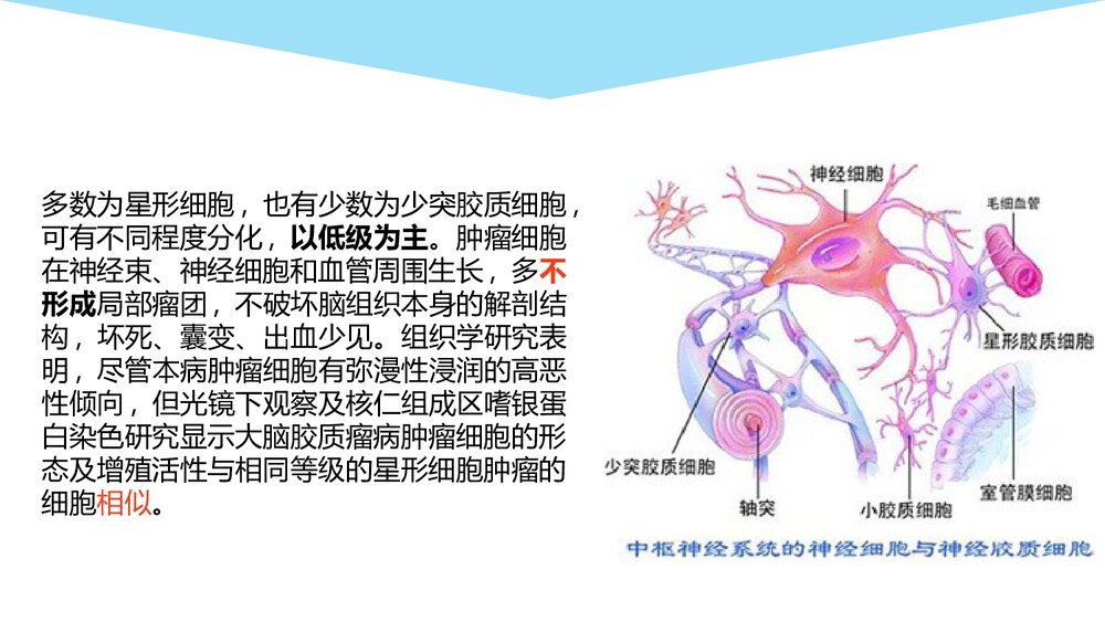大脑胶质瘤病影像学诊断PPT课件8