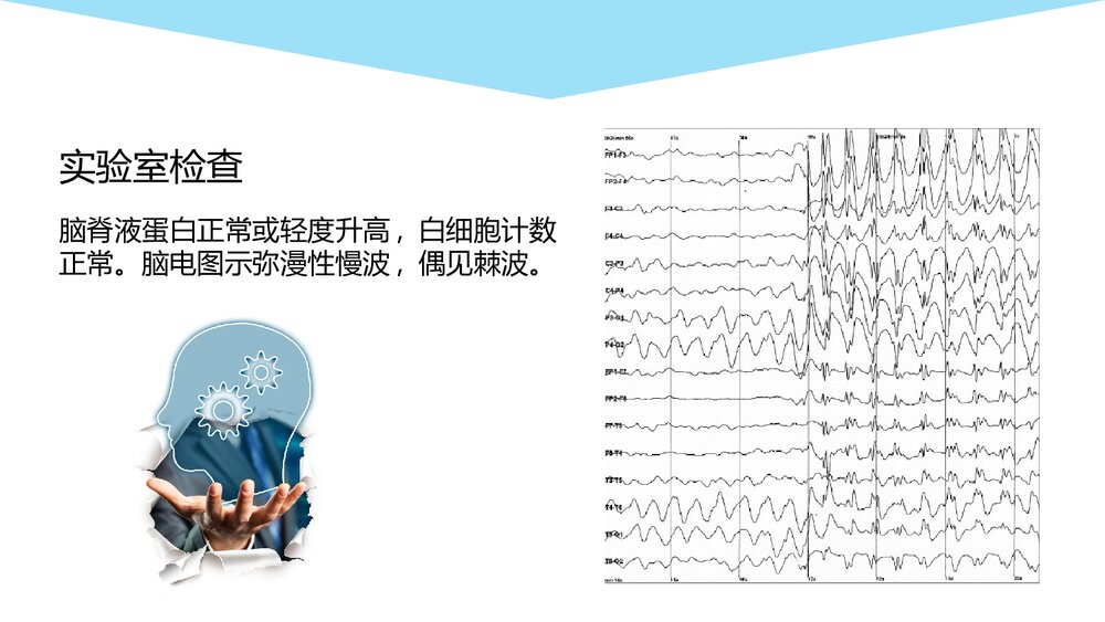 大脑胶质瘤病影像学诊断PPT课件9