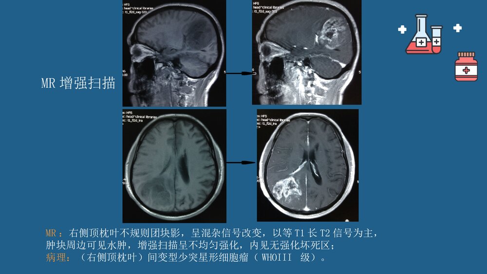灌注胶质瘤PPT课件 胶质瘤诊疗最新进展8