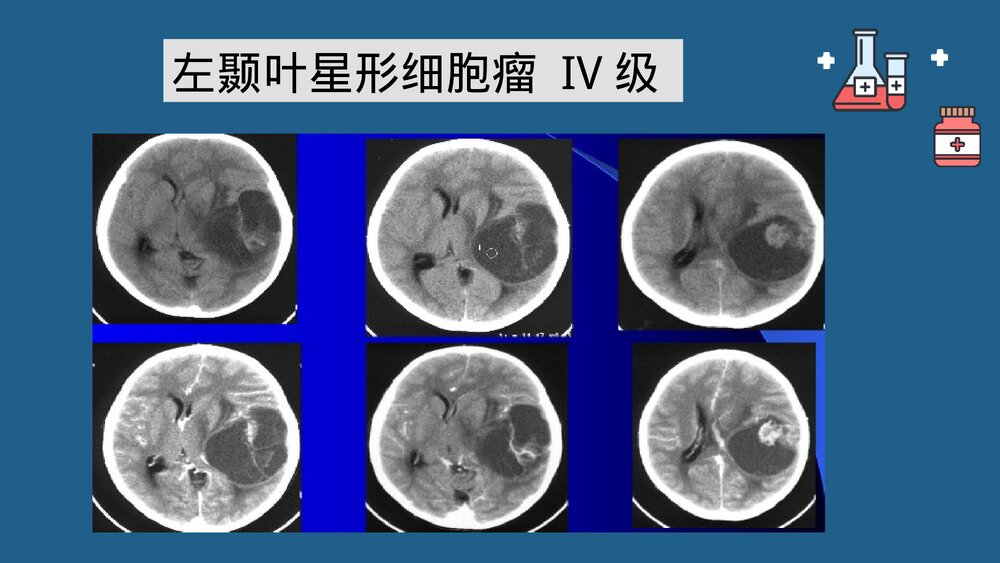 灌注胶质瘤PPT课件 胶质瘤诊疗最新进展10