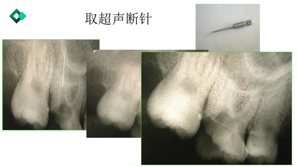根管治疗失败的原因与对策PPT课件10