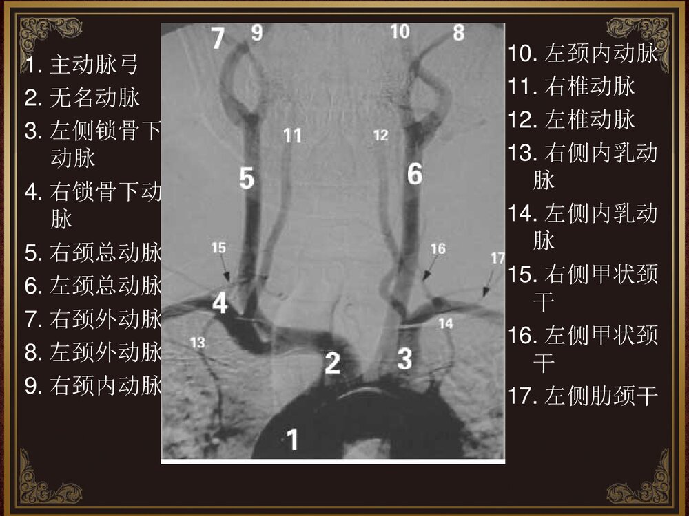 脑血管解剖及脑梗塞定位诊断PPT课件7