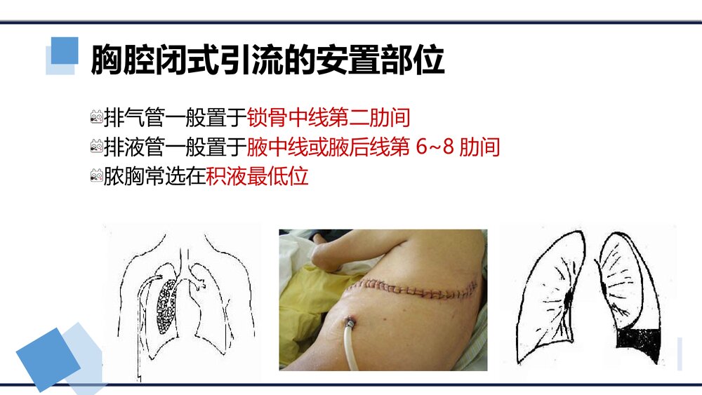 胸腔闭式引流的护理PPT课件(内容文字可编辑修改·共15页)8