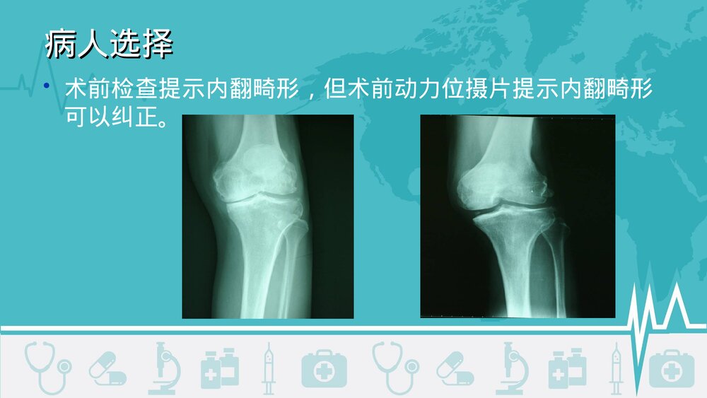 膝关节单髁置换术治疗内侧间室骨性关节炎PPT课件4