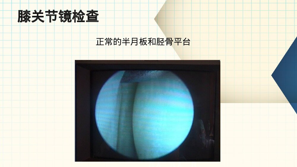 膝关节镜护理业务查房PPT课件(带内容·共61页)8