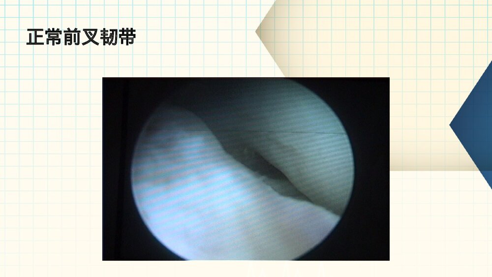 膝关节镜护理业务查房PPT课件(带内容·共61页)9