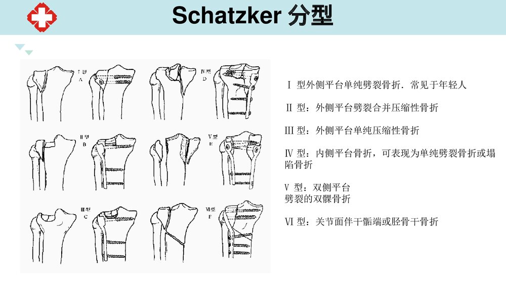 胫骨骨折手术配合PPT课件(内容文字可编辑修改共26页)10