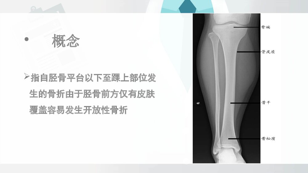 胫腓骨骨折病人围手术期的护理查房PPT课件(带内容·共19页)4