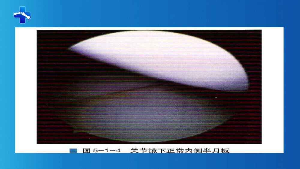 膝关节半月板损伤PPT课件(带内容·共68页)8