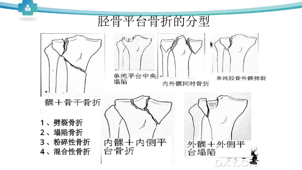 胫骨平台骨折分型治疗PPT课件6