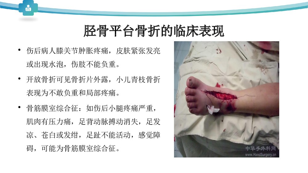 胫骨平台骨折分型治疗PPT课件7