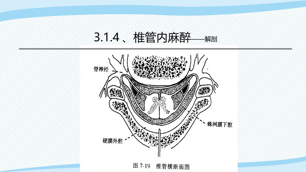 医疗教学课件之·椎管内麻醉PPT课件(带内容)6