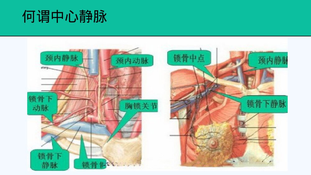 中心静脉置管及护理PPT课件共28页·内容可编辑修改)2