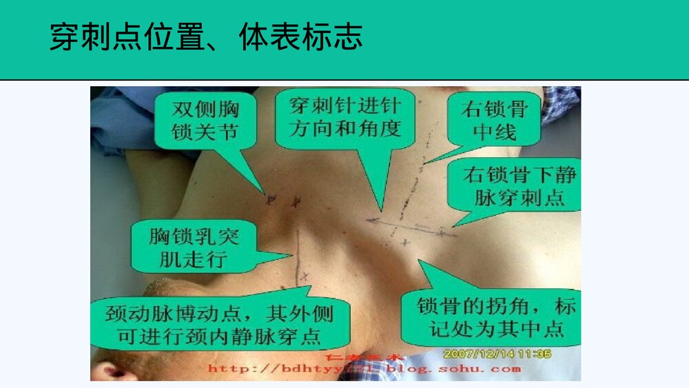 中心静脉置管及护理PPT课件共28页·内容可编辑修改)6