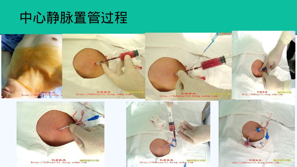 中心静脉置管及护理PPT课件共28页·内容可编辑修改)7