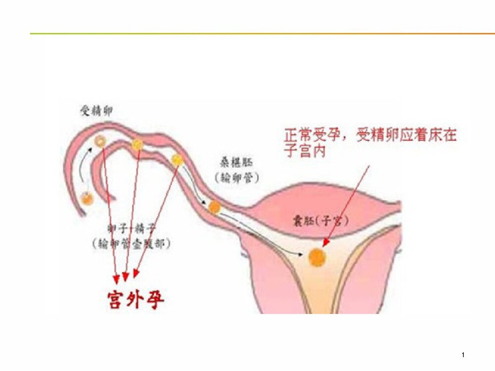 宫外孕的急救护理PPT课件(电子版·可编辑修改)8