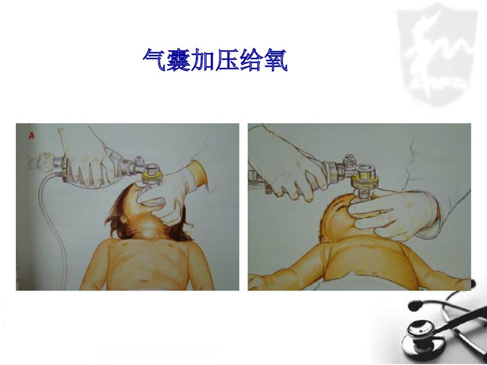 小儿气管插管术PPT课件(带内容文字·图片)7