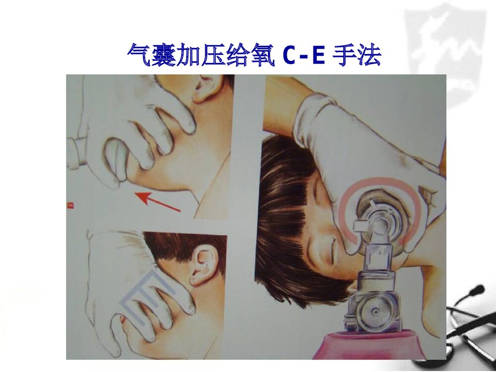 小儿气管插管术PPT课件(带内容文字·图片)8