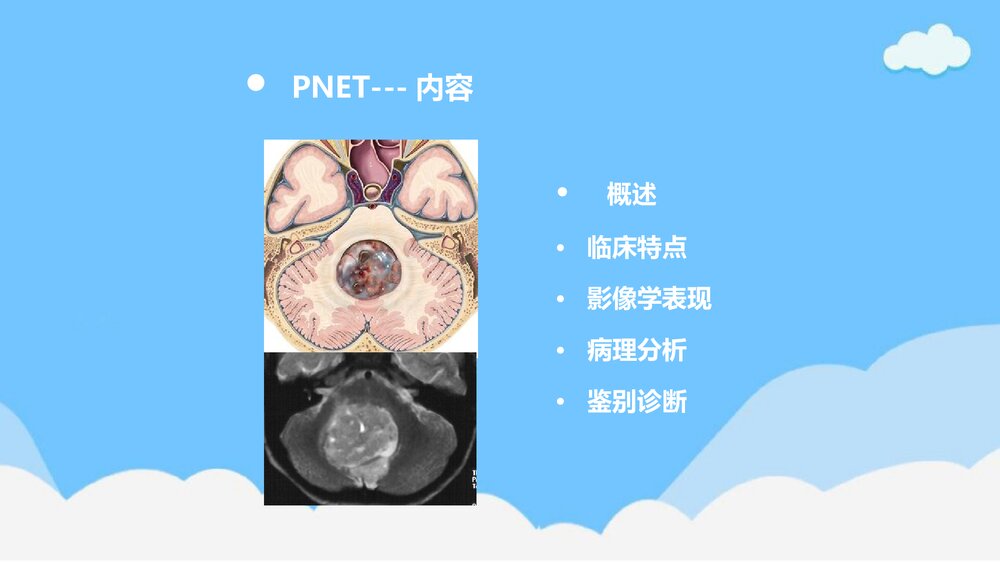 原始神经外胚层肿瘤(PNET)PPT课件下载(含内容)2