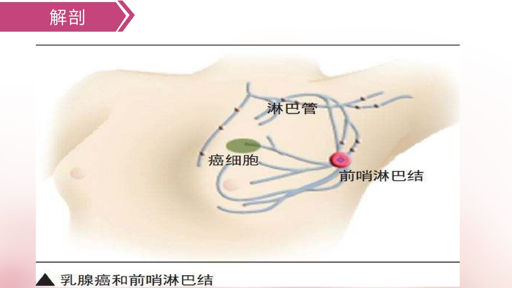 乳腺癌手术的护理配合PPT课件下载6