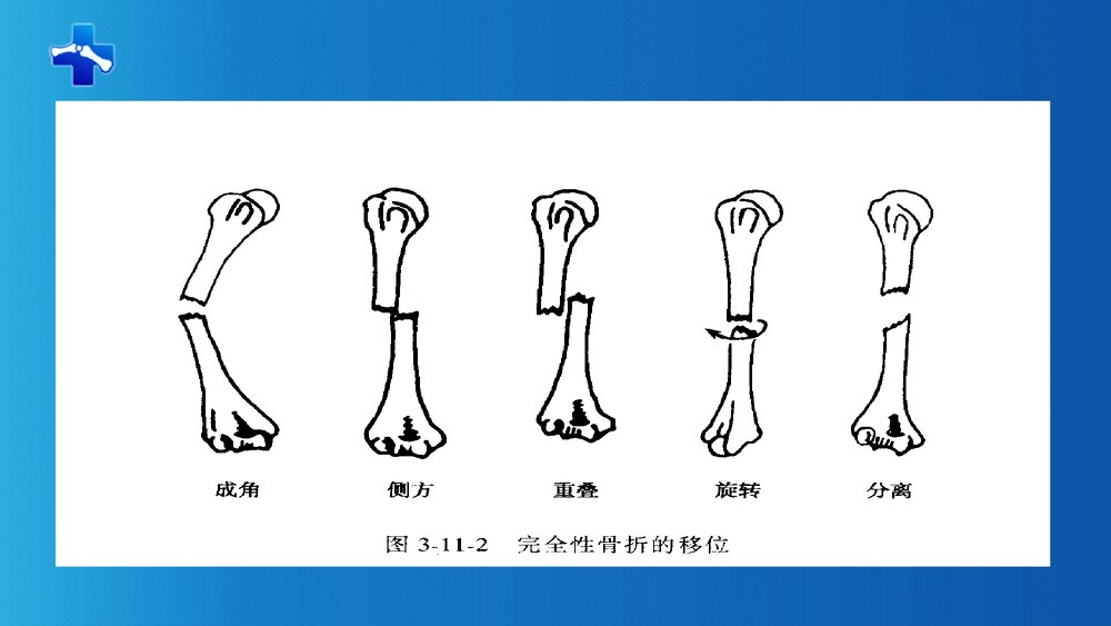 骨与关节疾病病人的护理PPT课件下载10