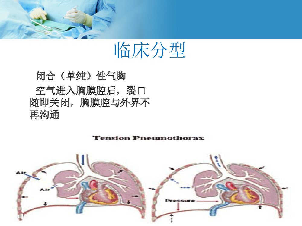自发性气胸护理教学查房PPT课件下载5